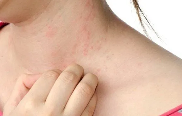 Skin rash and itching on the neck as a common symptom of food allergy