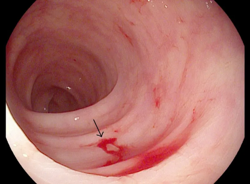 Endoscopic image showing gastrointestinal bleeding in a patient with immune thrombocytopenia