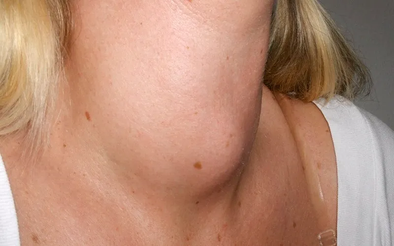 Goiter Enlarged thyroid gland causing visible neck swelling in goiter.