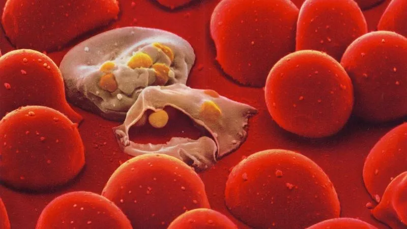 Microscopic view of red blood cells showing hemolysis in hemolytic anemia.