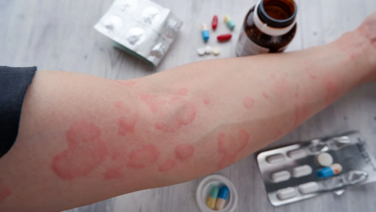 Medications prescribed by a doctor to treat hives and reduce skin inflammation