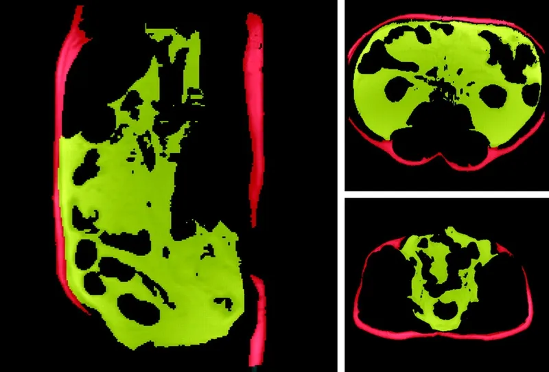 MRI scan showing abnormal body fat distribution in lipodystrophy
