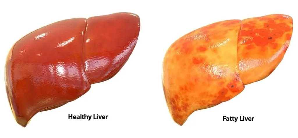 comparison between healthy liver and fatty liver in lipodystrophy
