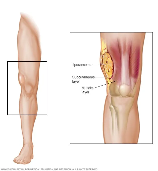 Medical illustration showing liposarcoma tumor in the leg located in the subcutaneous and muscle layers