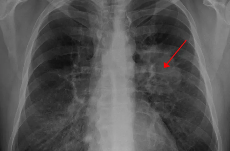 Chest X-ray showing a lung tumor highlighted with a red arrow