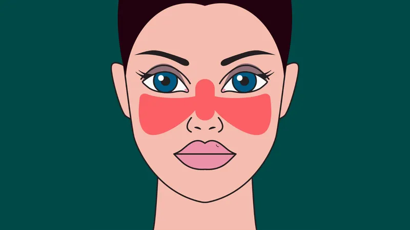 Illustration showing butterfly rash on face as a common sign of lupus, a cause of blood clotting disorders