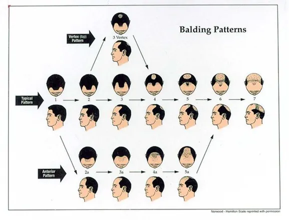 Illustration showing the progressive stages of male pattern baldness caused by genetic and hormonal factors
