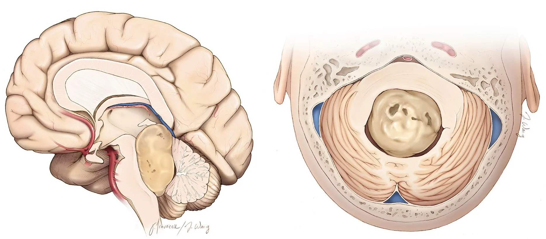 Medulloblastoma Illustration showing medulloblastoma tumor in the cerebellum and fourth ventricle of the brain