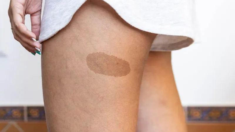 Cafe au lait spots on the skin, an early sign of neurofibromatosis type 1 (NF1)