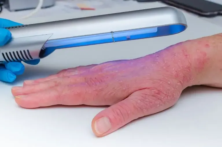 Psoriasis Phototherapy using ultraviolet light to treat psoriasis on the hand