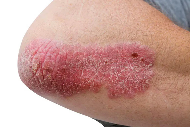 Psoriasis Plaque psoriasis on the elbow showing thick, scaly, red patches of skin