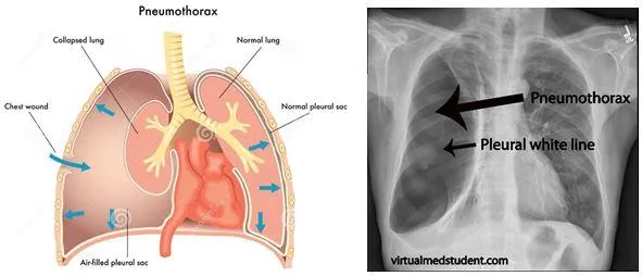 Medical illustration and chest X-ray showing pneumothorax with collapsed lung and pleural white line