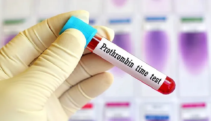 Blood sample for Prothrombin Time (PT) test used to evaluate blood clotting function