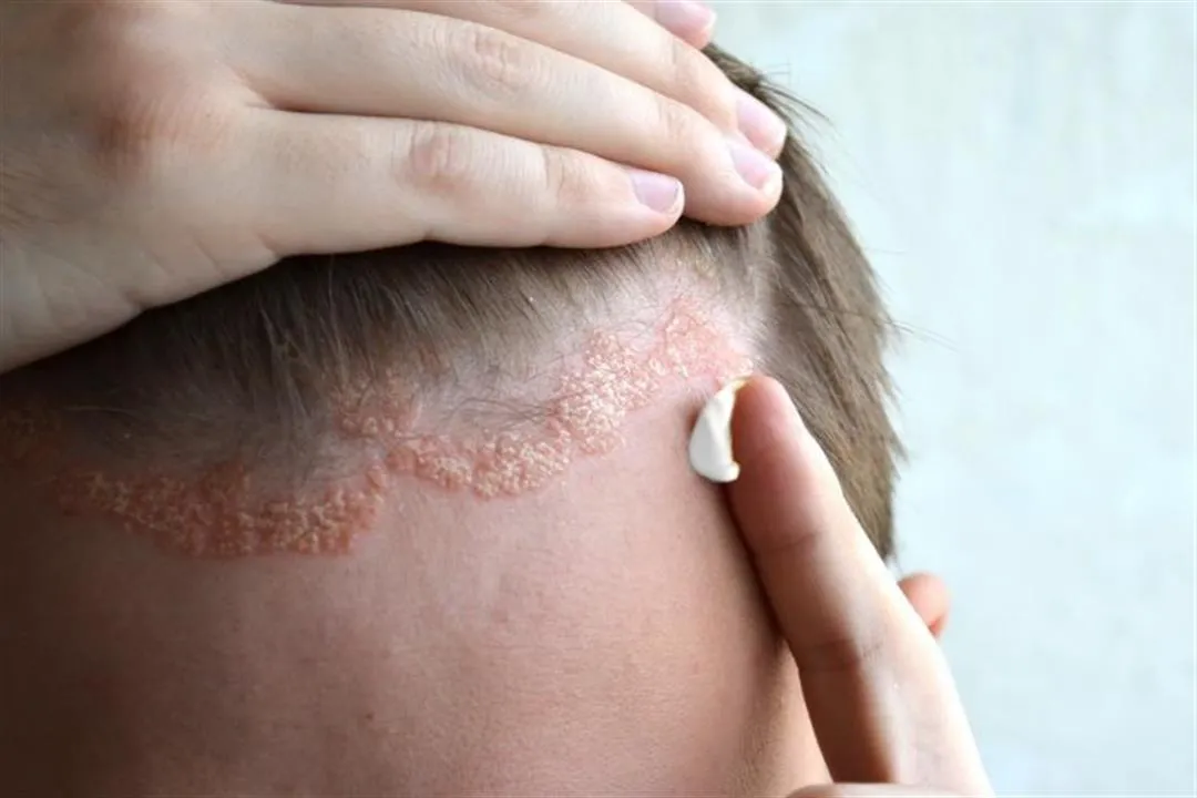 Psoriasis Applying topical cream to scalp affected by psoriasis