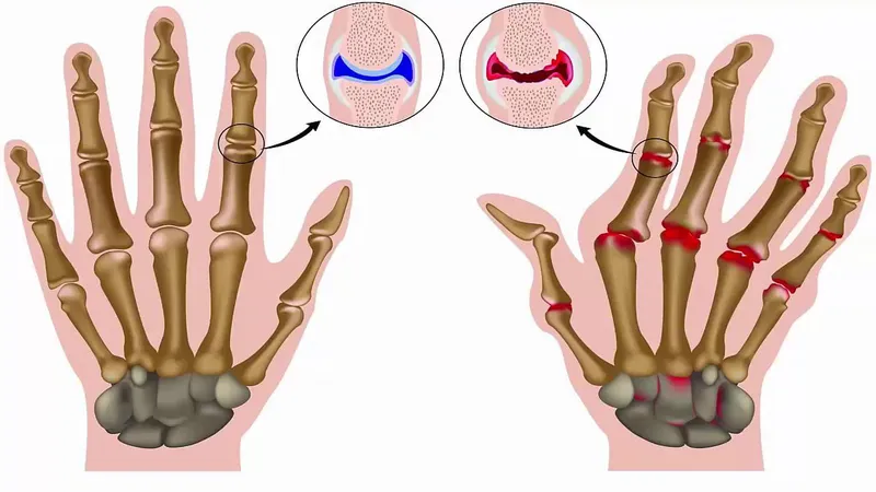 Illustration showing joint damage in rheumatoid arthritis, a condition that increases the risk of immune thrombocytopenia