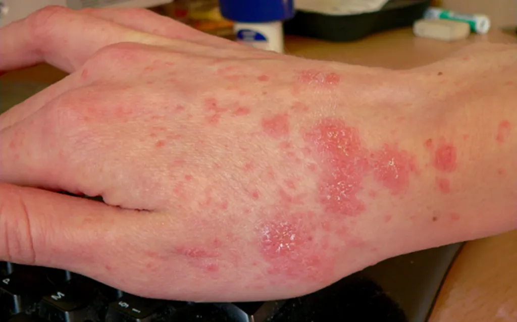 Scabies rash on the hand caused by Sarcoptes scabiei mite infestation