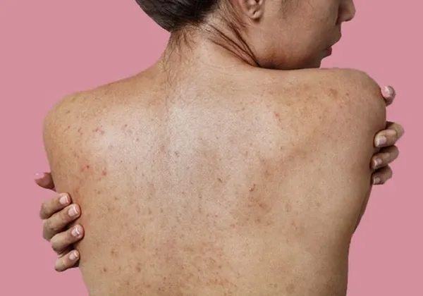 Woman with seborrheic dermatitis on her back, showing red and flaky skin