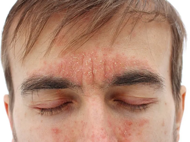 Seborrheic dermatitis causing red, flaky skin on the forehead and eyebrows