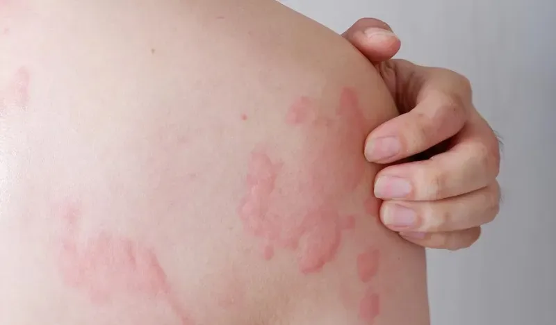 Red itchy rash on the shoulder caused by skin allergy or contact dermatitis.
