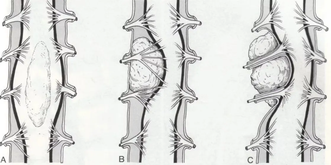 Illustration of spinal ependymoma showing different tumor growth patterns within the spinal cord