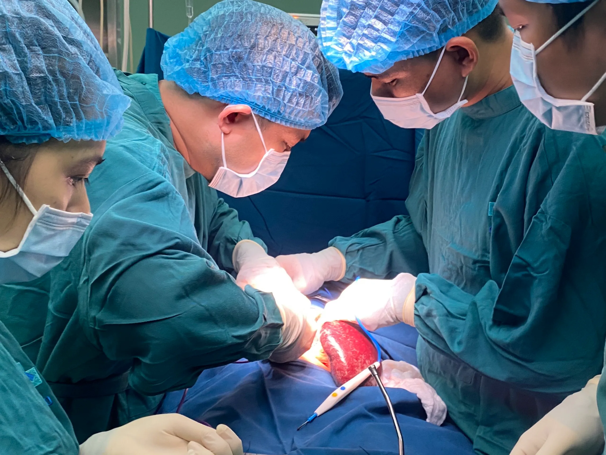 Surgeons performing splenectomy surgery as a treatment for immune thrombocytopenia