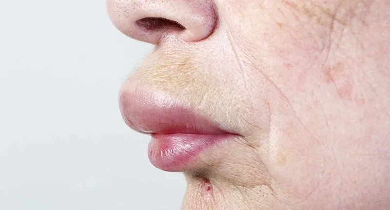 Close-up of swollen upper lip caused by inflammation or allergic reaction.