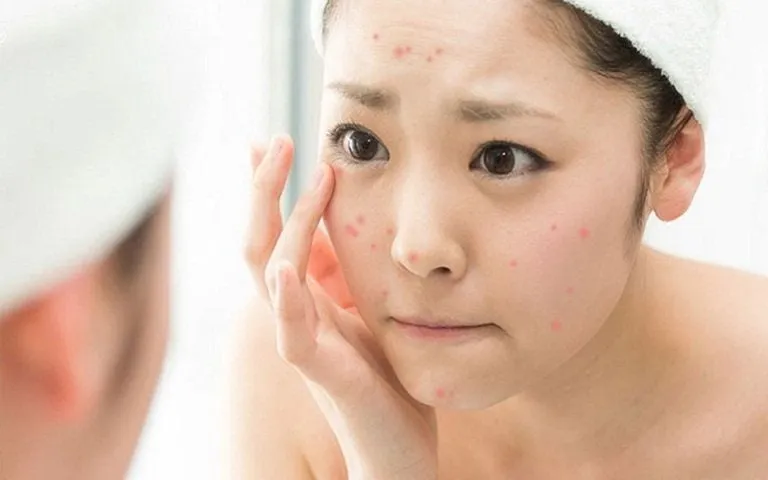 Teen with mild hormonal acne looking at facial blemishes in the mirror