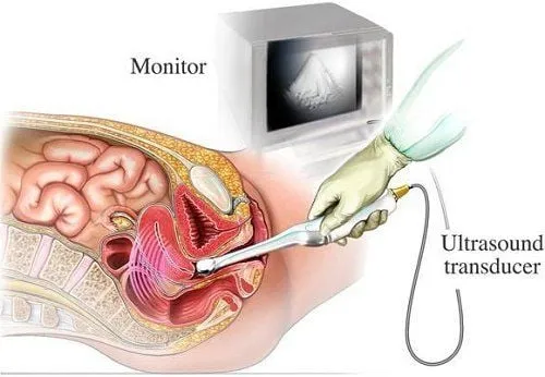 Illustration of transvaginal ultrasound used in gynecological examination to detect endometrial cancer
