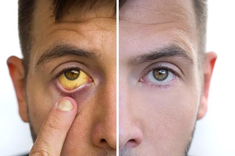 Close-up comparison image showing the eye of a person with jaundice (yellow sclera) on the left side, contrasted with a healthy eye on the right side.