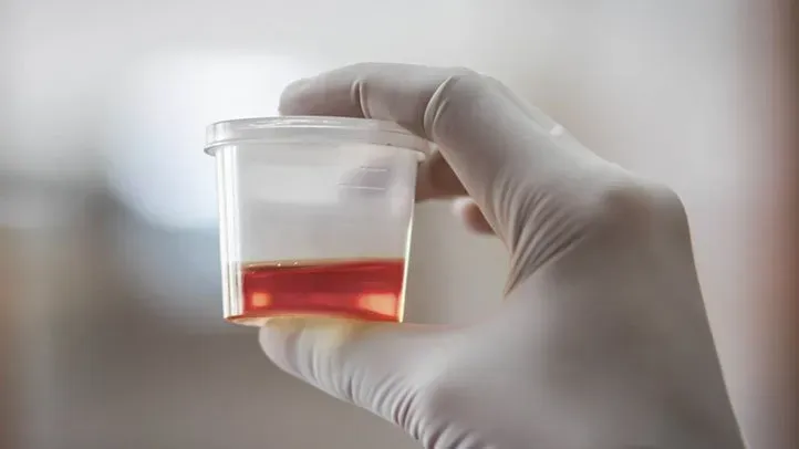 What Do Kidney Function Tests Include and What Do They Mean? Urine sample with visible blood indicating hematuria