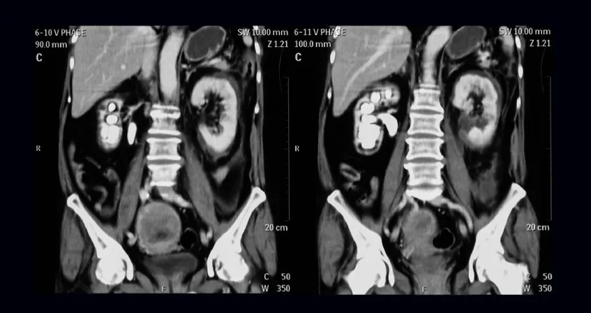 What Do Kidney Function Tests Include and What Do They Mean? Coronal CT scan showing both kidneys with contrast enhancement for diagnostic evaluation