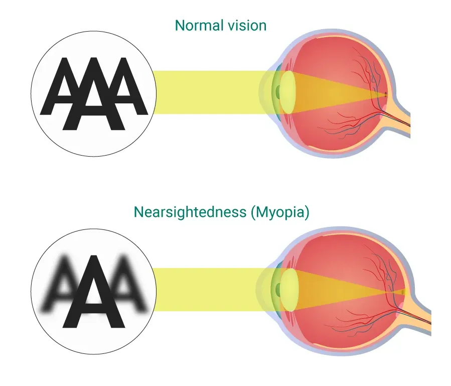 Diagram showing light focus in normal vision versus nearsightedness (myopia)