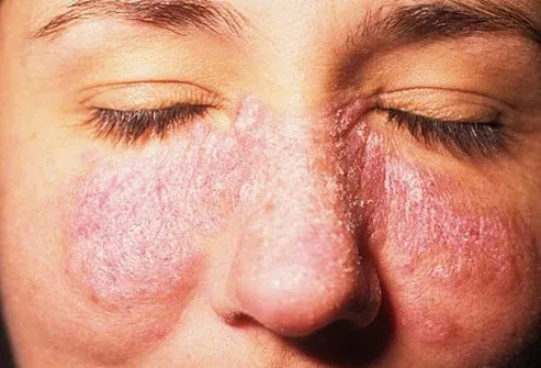 Red scaly lesions on the face caused by discoid lupus erythematosus