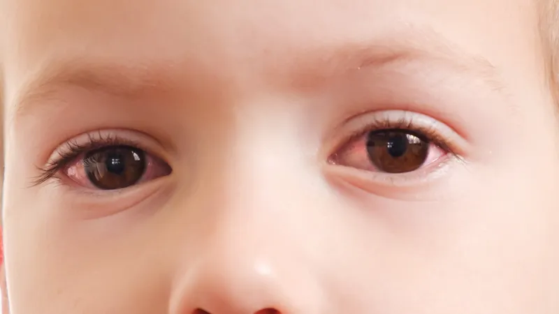 Child with red eyes, discharge, and watery irritation caused by eye inflammation