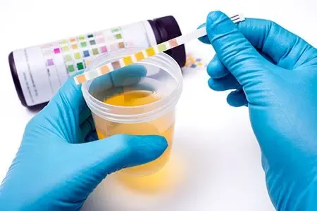 What Do Kidney Function Tests Include and What Do They Mean? Dipstick urinalysis being performed on a urine sample