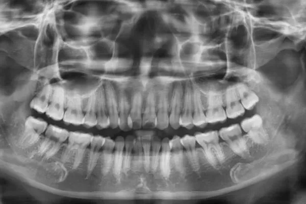 Panoramic dental X-ray used to assess tooth and jaw conditions