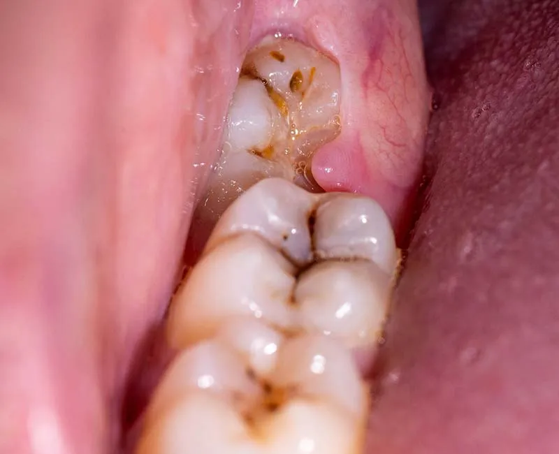 Partially erupted impacted wisdom tooth with inflamed gum tissue