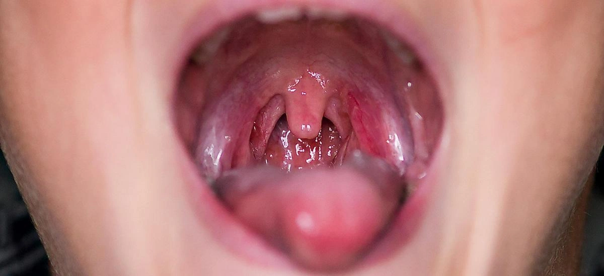 An open mouth view showing atrophic tonsillitis with shrunken, scarred tonsil tissue and a inflamed pharyngeal back wall