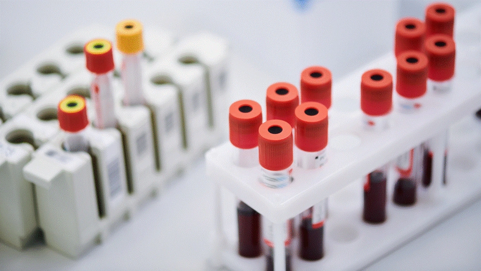 Blood collection tubes with red and yellow caps in a laboratory rack for diagnostic blood tests of atrophic tonsillitis