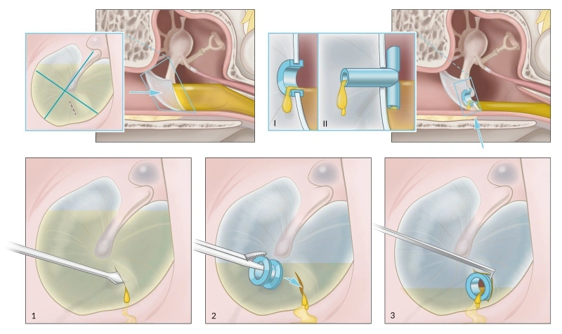 A medical diagram illustrating the steps of a myringotomy with tympanostomy tube insertion to drain fluid and relieve pressure in the middle ear