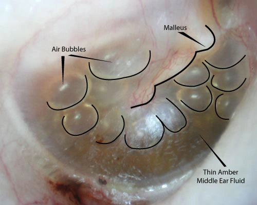An otoscopic view of a patient with otitis media with effusion, showing a thin amber fluid and multiple air bubbles behind the tympanic membrane.