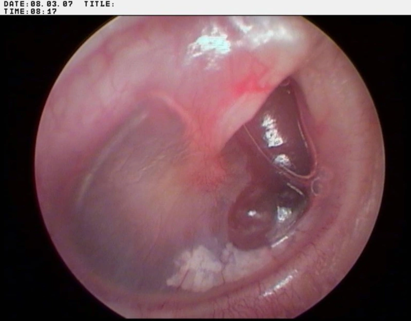 An otoscopic view of the eardrum revealing internal middle ear structures and trapped air bubbles behind the tympanic membrane