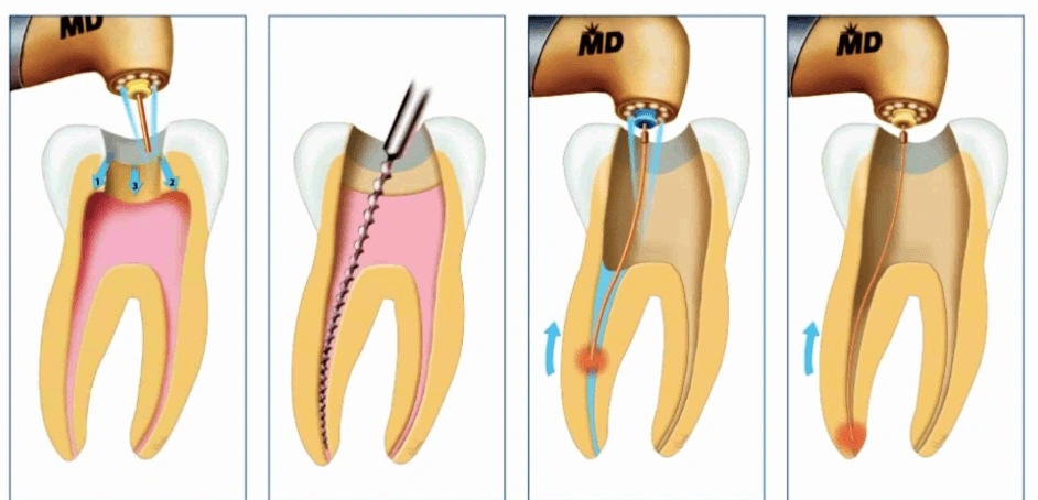 A 4-step medical diagram illustrating root canal treatment procedure for a severely decayed tooth, from drilling to cleaning and sealing the canal