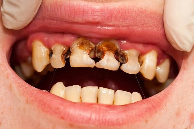 A close-up view of severe tooth decay and advanced dental caries affecting multiple upper front teeth