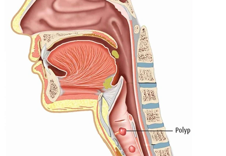 Voice Disorders A medical cross-section diagram of the human upper respiratory tract highlighting a vocal cord polyp as a common cause of voice disorders